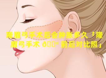 隆眉弓手术后会肿胀多久「隆眉弓手术 💮 前后对比照」